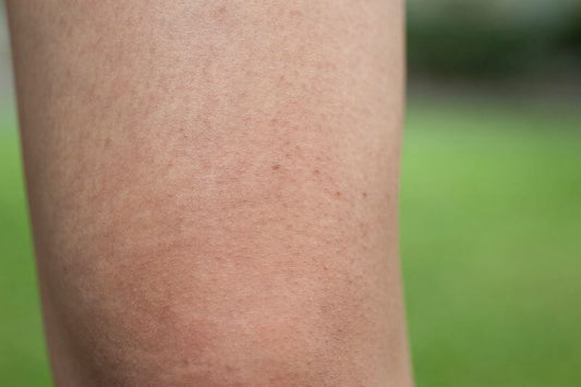 Guide complet pour éliminer la peau de fraise sur les jambes : Astuces et méthodes efficaces